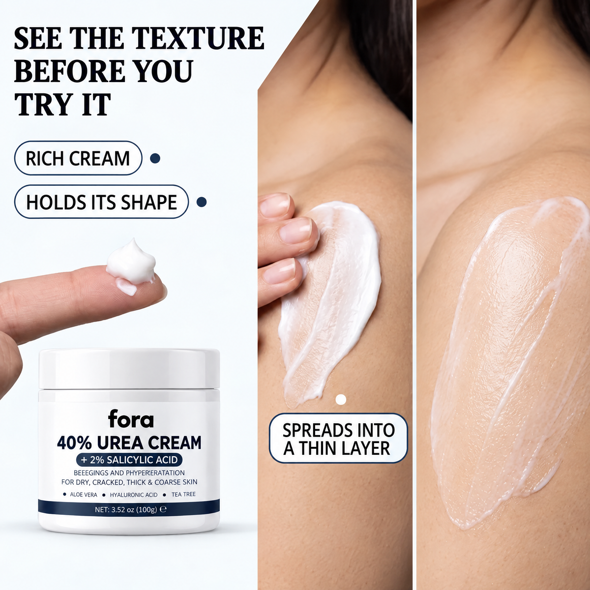 SK Renewal 40 — Advanced Keratolytic Cream For Rough, Raised Seborrheic Keratoses